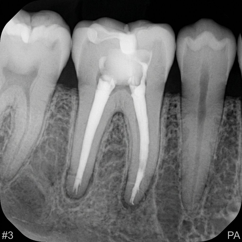 Endodoncia